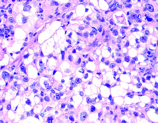 Pathology Outlines Pleomorphic